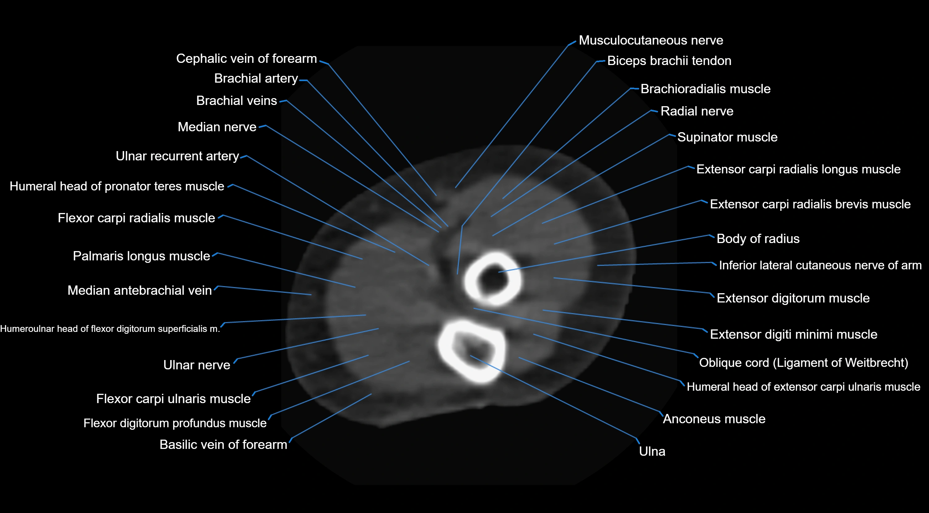 CT elbow axial  cross sectional anatomy labelled  radiology image -00041.webp